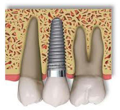 implante dental titanio